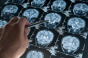 pointing pen at brain mri