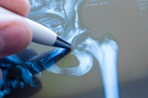 pen pointing at hip x-ray