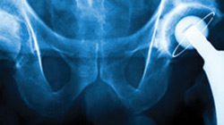 DePuy Hip Implants photo