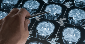 How Memory Loss Could Impact Your Claim for Compensation