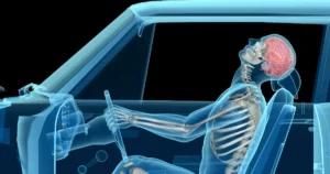 Whiplash After a Minnesota Car Crash: What Is It and Why Do I Need a Lawyer to Prove My Claim?